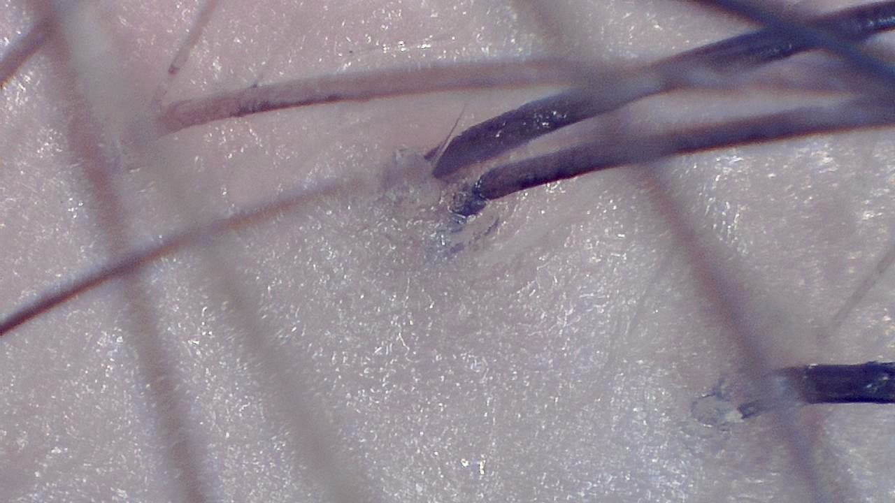Trichoscopy for Hair and Scalp microscopy sample image 2