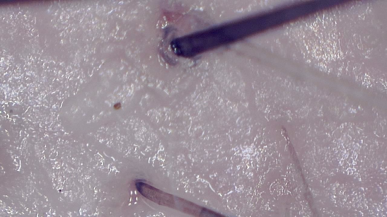 Trichoscopy for Hair and Scalp microscopy sample image 3