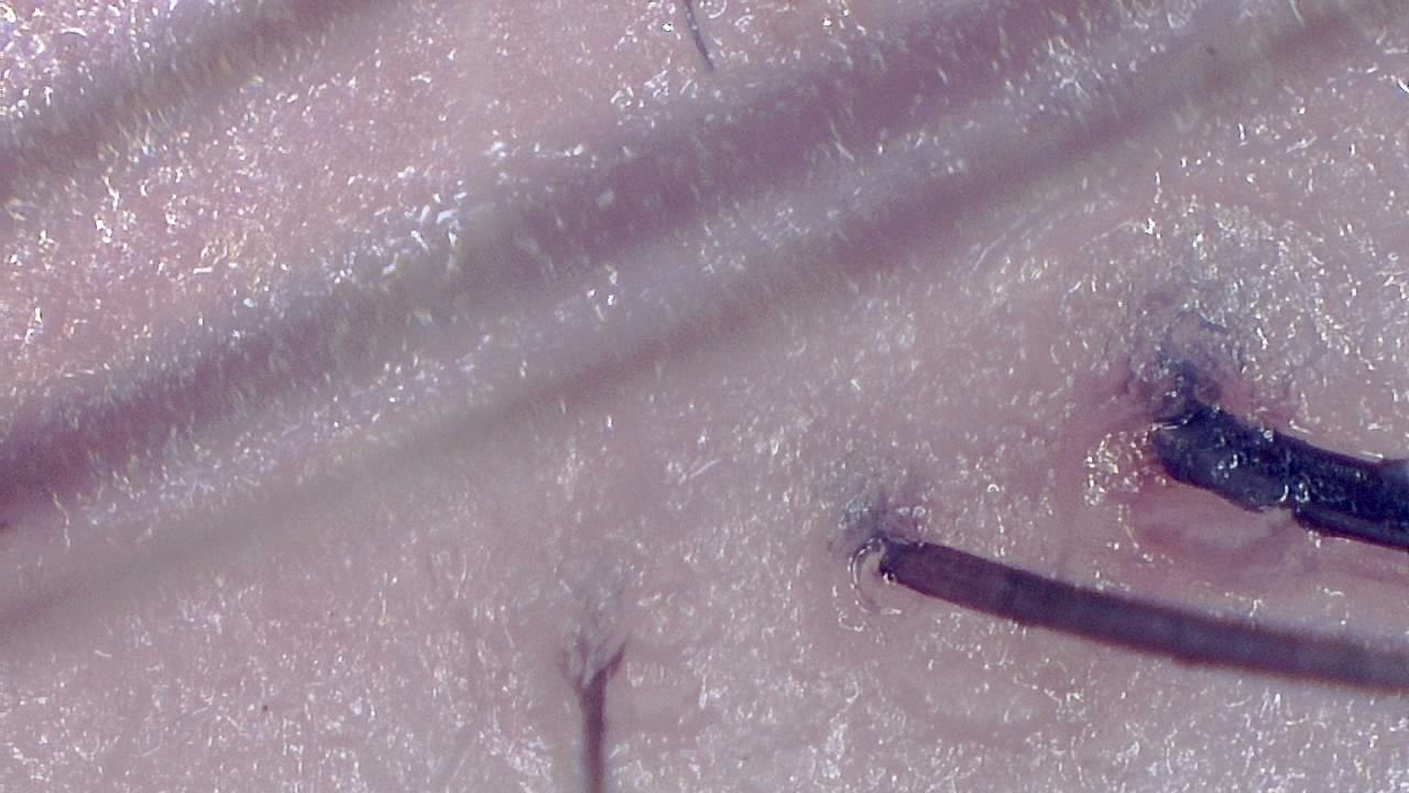 Trichoscopy for Hair and Scalp microscopy sample image 4