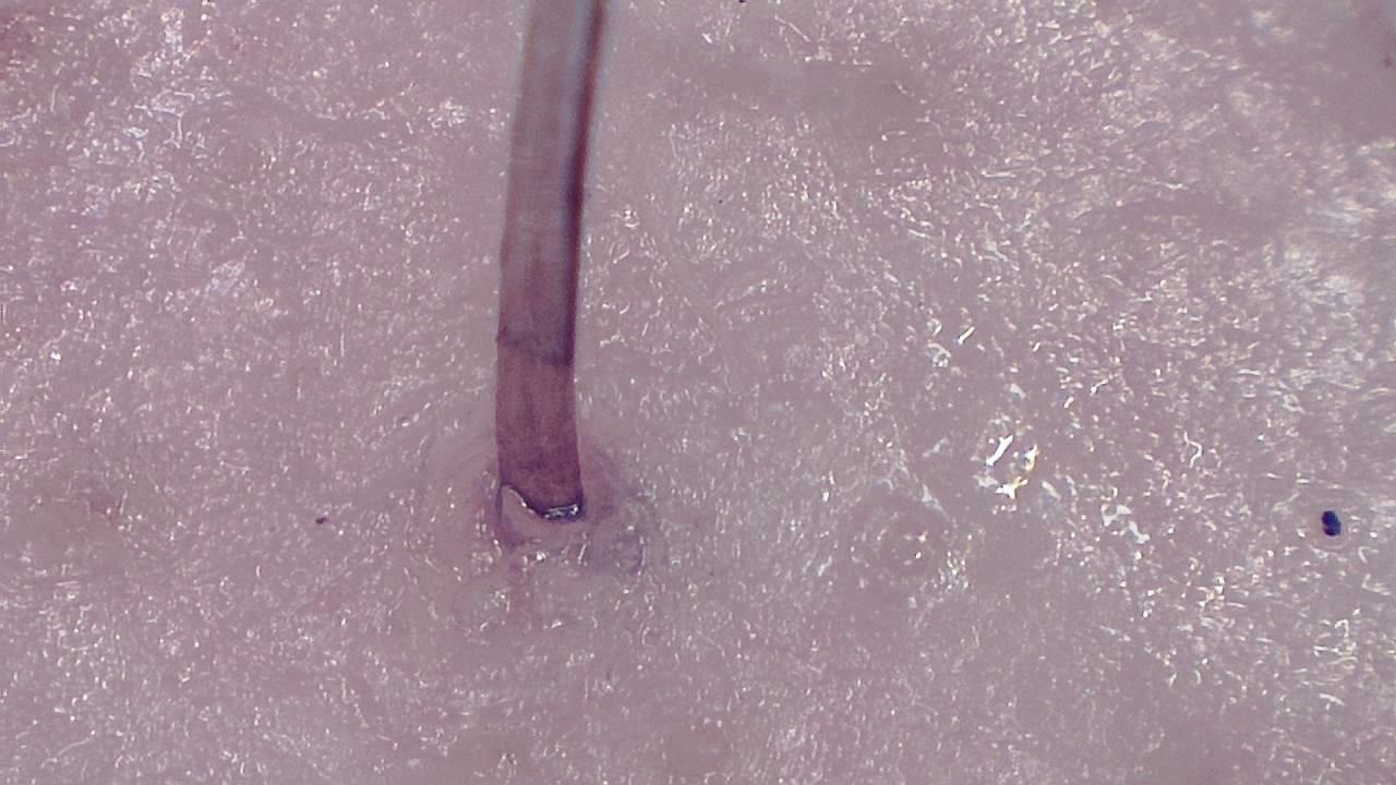 Trichoscopy for Hair and Scalp microscopy sample image 7